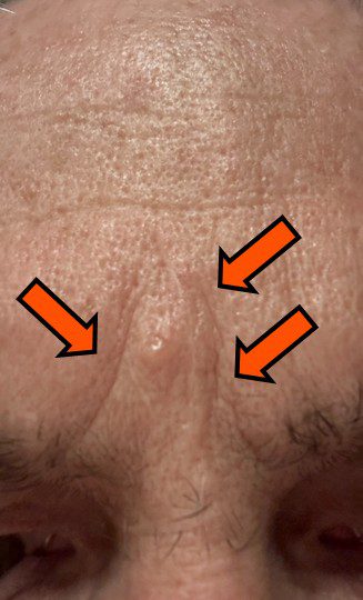 rifle recoil scars on forehead